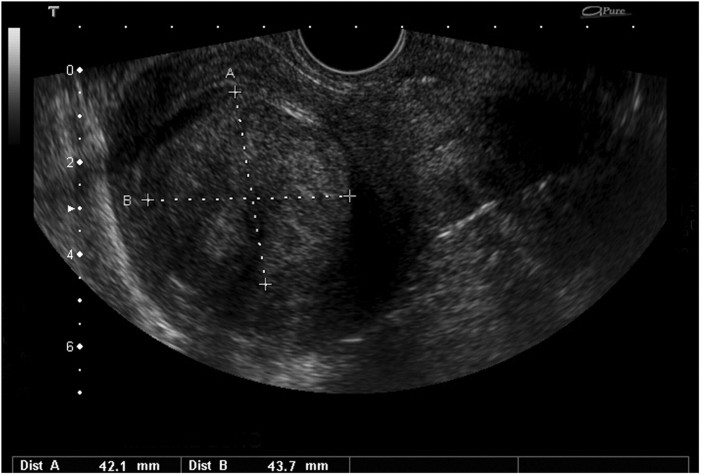 myoma ultrasound.jpg